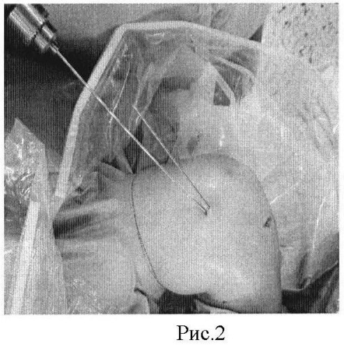 Способ оперативного лечения рассекающего остеохондрита мыщелков бедренной кости у детей и подростков (патент 2476177)