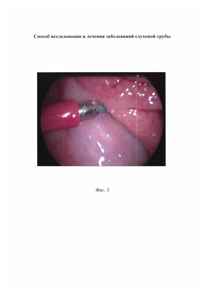 Способ исследования и лечения заболеваний слуховой трубы (патент 2630352)
