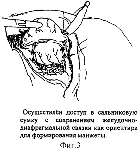 Способ фундопликации (патент 2291672)