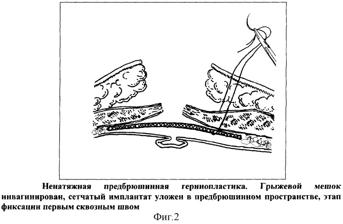 Способ ненатяжной предбрюшинной герниопластики пупочных, параумбиликальных и грыж белой линии живота (патент 2291670)