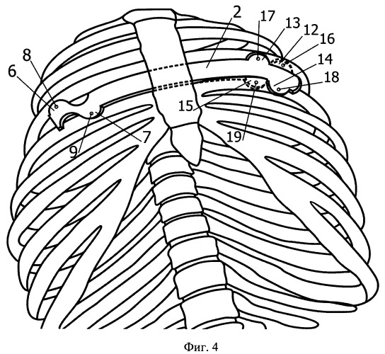 Способ хирургического лечения воронкообразной деформации грудной клетки и устройство для его осуществления (патент 2496438)