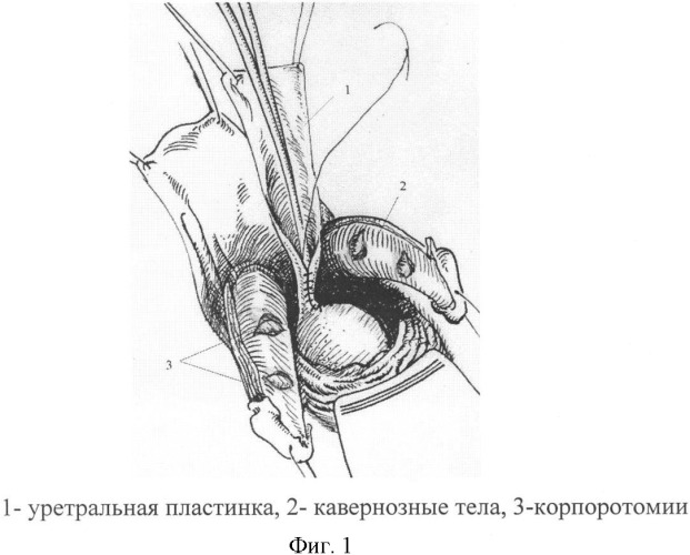 Пещеристое тело. Экстрофия мочевого пузыря, эписпадия. Экстрофия полового члена. Мочевой пузырь при эписпадии. Хирургическое лечение полового члена.