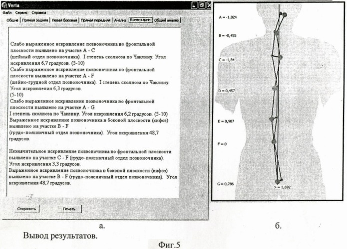 Способ цифровой диагностики деформаций позвоночника (патент 2392855)