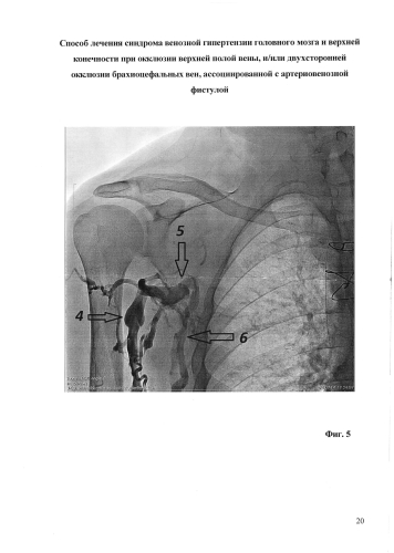 Способ лечения синдрома венозной гипертензии головного мозга и верхней конечности при окклюзии верхней полой вены и/или двусторонней окклюзии брахиоцефальных вен, ассоциированной с артериовенозной фистулой (патент 2573802)
