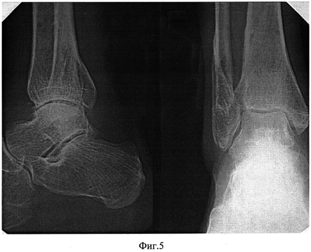 Способ лечения застарелых неправильно сросшихся пронационно-эверсионных переломов дистального отдела костей голени (патент 2528819)