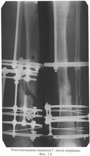 Способ лечения несросшихся переломов и ложных суставов костей голени, осложненных хроническим травматическим остеомиелитом (патент 2311144)