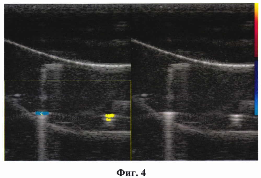 Способ выявления аномалий физической плотности при акустической визуализации (патент 2665223)