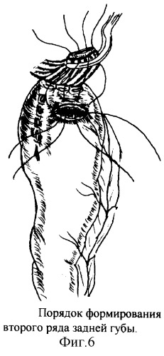Новый способ формирования эзофагогастроанастомоза в условиях недостатка пластического материала путем модификации задней губы (патент 2248185)