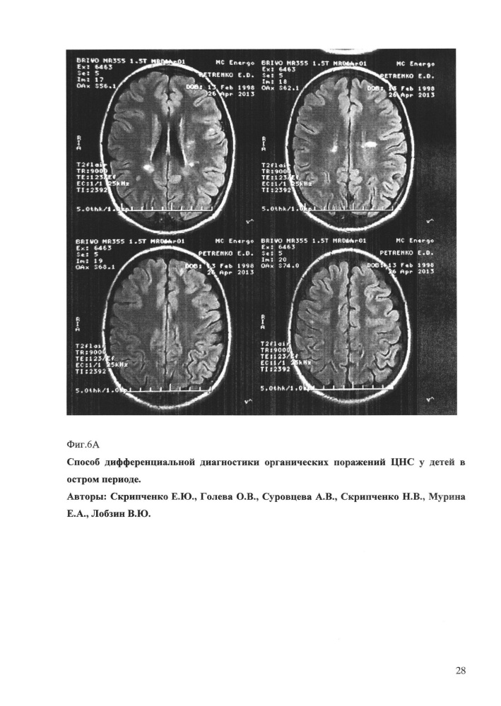 Способ дифференциальной диагностики органических поражений цнс у детей в остром периоде (патент 2648215)
