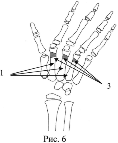 Способ лечения врожденной разгибательной контрактуры лучезапястного сустава в сочетании со сгибательными контрактурами и ульнарной девиацией трехфаланговых пальцев на уровне пястно-фаланговых суставов у детей с артрогрипозом (патент 2553941)