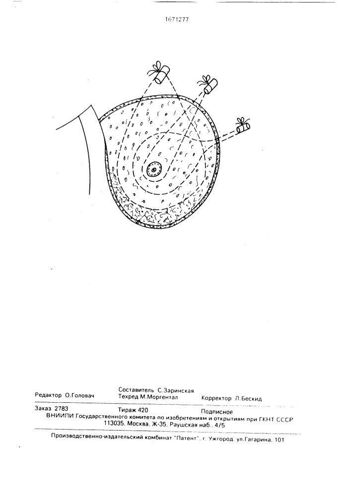 Способ восстановления формы молочной железы после ожогов (патент 1671277)