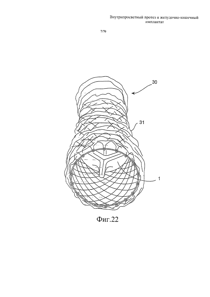 Внутрипросветный протез и желудочно-кишечный имплантат (патент 2626885)