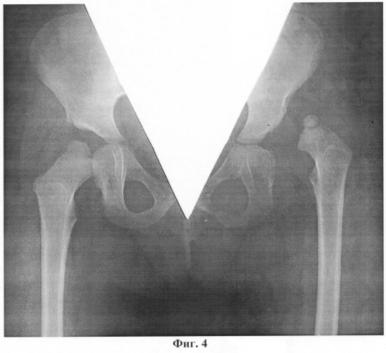 Способ хирургического лечения детей с патологией тазобедренного сустава (патент 2405486)