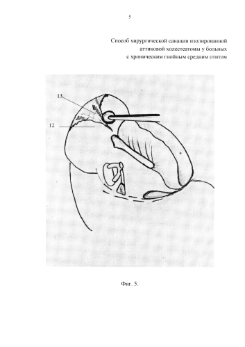 Способ хирургической санации изолированной аттиковой холестеатомы у больных с хроническим гнойным средним отитом (патент 2580041)
