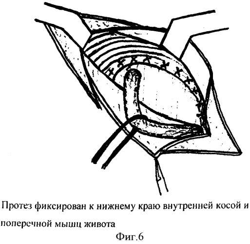 Способ герниопластики при паховых грыжах (патент 2338467)