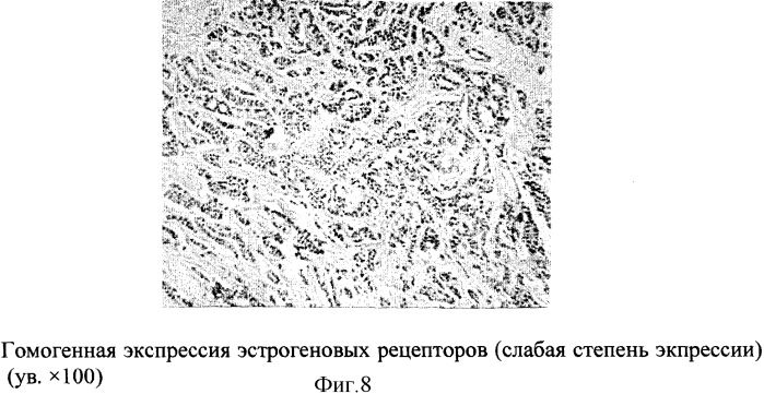 Способ прогнозирования течения заболевания раком молочной железы (патент 2300111)