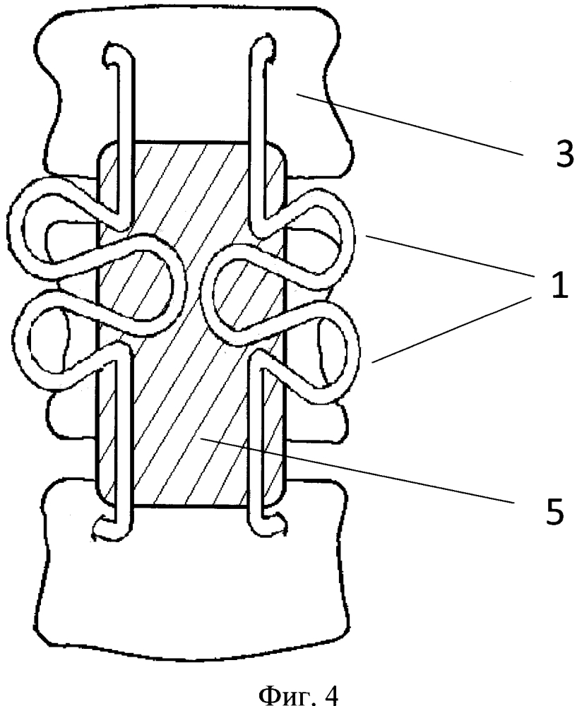 Устройство для фиксации поясничного отдела позвоночника (патент 2596094)