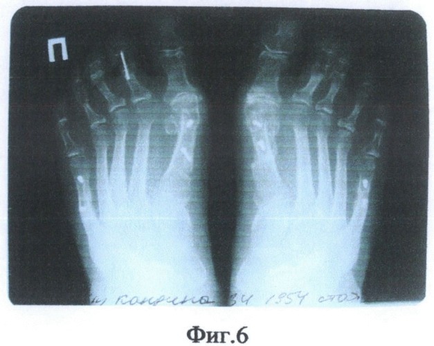 Способ межфалангового артродеза после коррекции ригидной молоткообразной деформации средних пальцев стопы (патент 2487683)