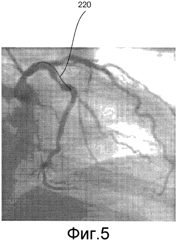 Картирование сосудов (патент 2570758)