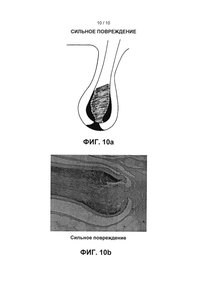 Способ улучшенной фотоэпиляции на основе нанокомплексов металлов (патент 2630976)