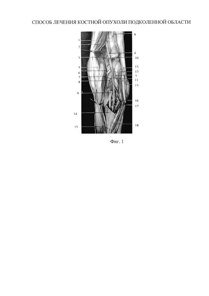 Способ лечения костной опухоли подколенной области (патент 2611889)