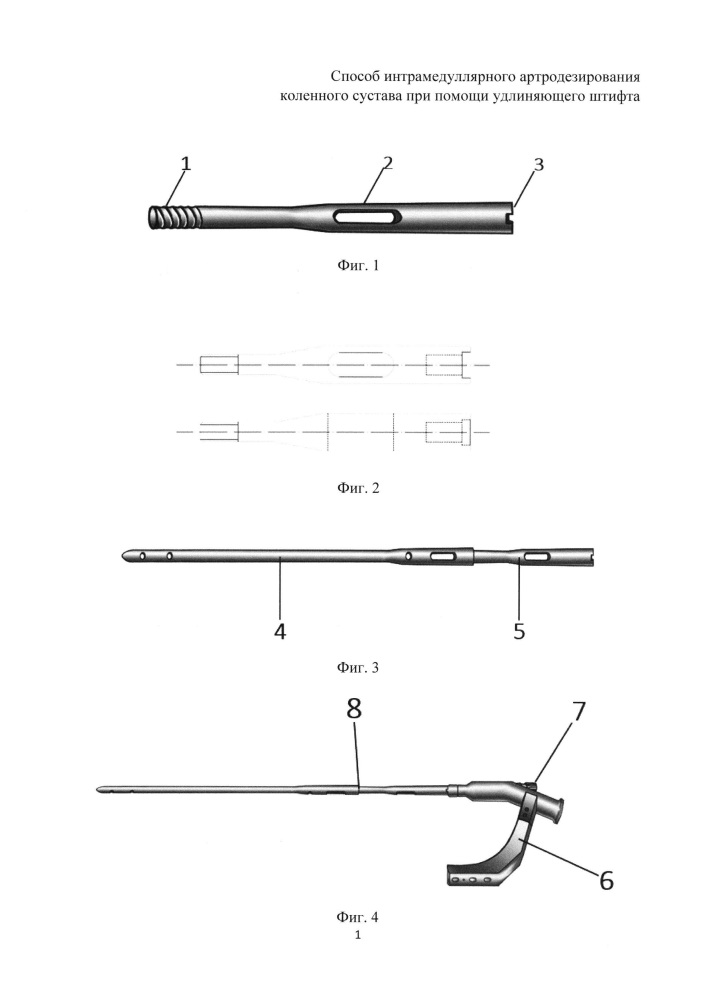 Способ интрамедуллярного артродезирования коленного сустава при помощи удлиняющего штифта (патент 2624674)