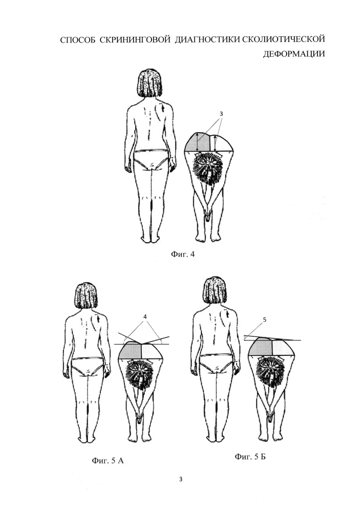 Способ скрининговой диагностики сколиотической деформации (патент 2638644)