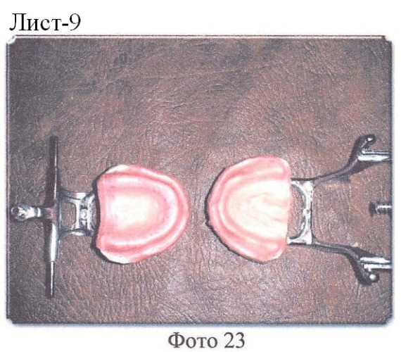 Миодинамический мягкий полный съемный протез. способ изготовления миодинамического мягкого полного съемного протеза (патент 2384308)