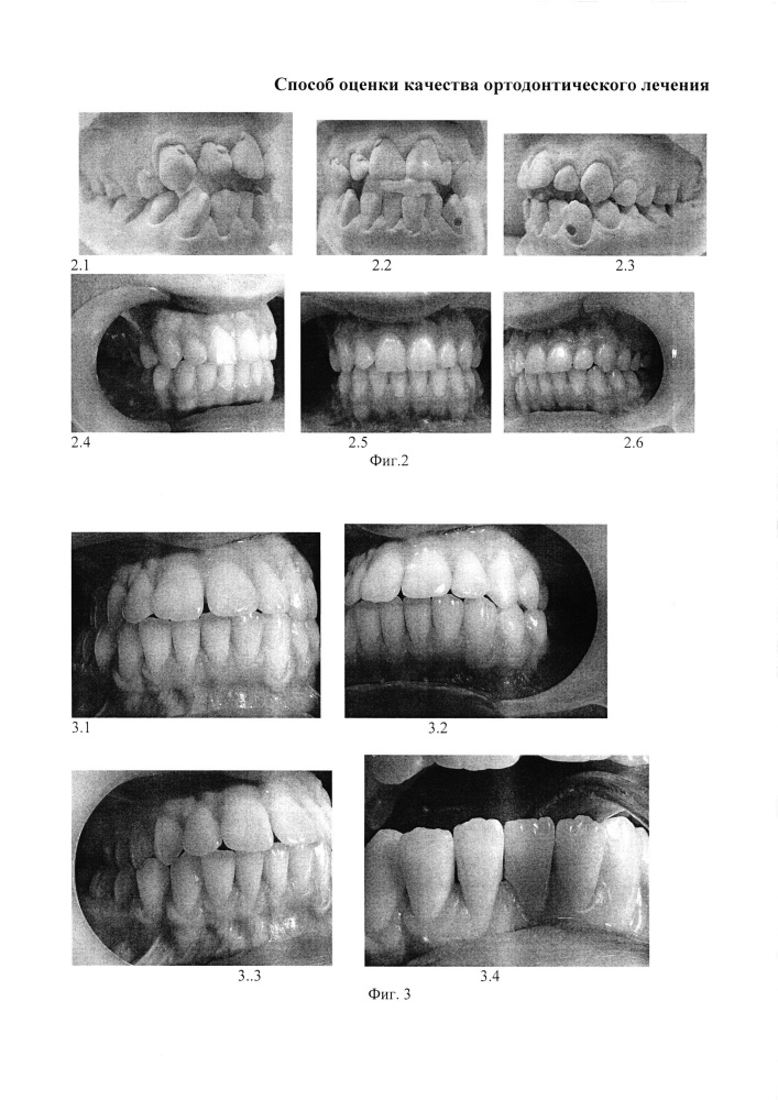Способ оценки качества ортодонтического лечения (патент 2616761)