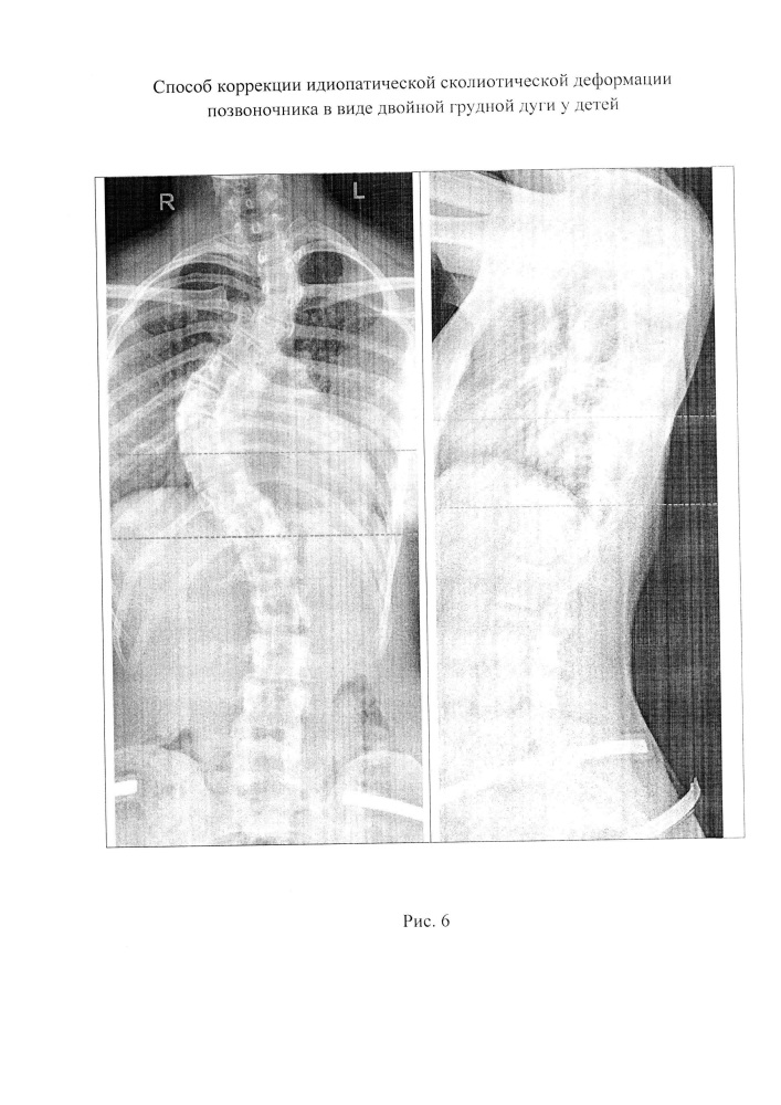 Способ коррекции идиопатической сколиотической деформации позвоночника в виде двойной грудной дуги у детей (патент 2651111)