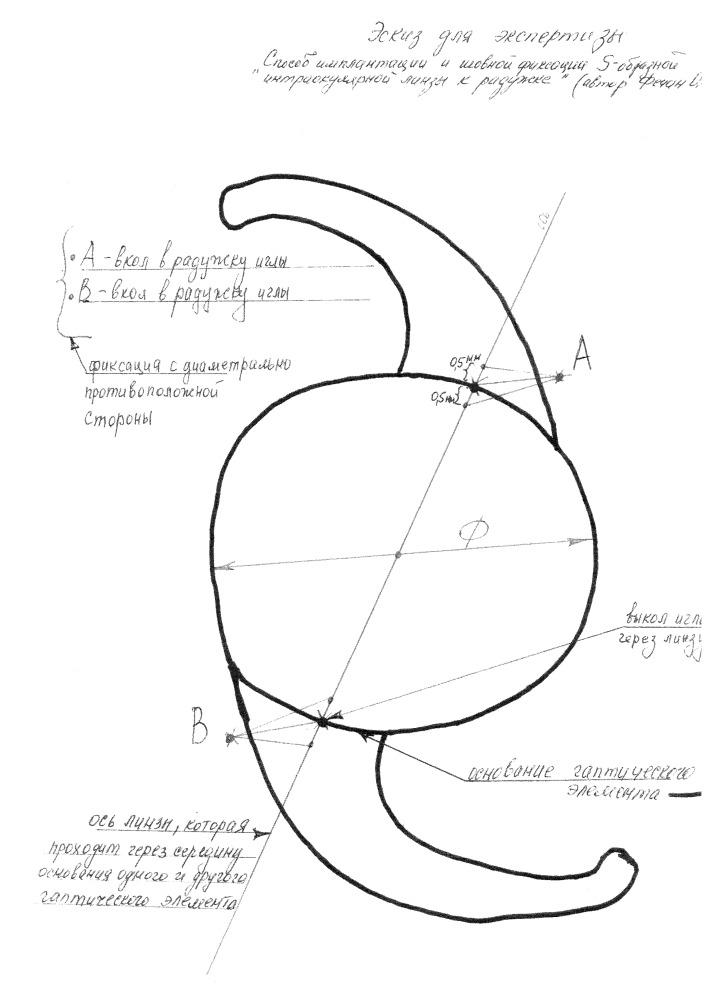 Способ имплантации и шовной фиксации s-образной интраокулярной линзы к радужке (патент 2665182)