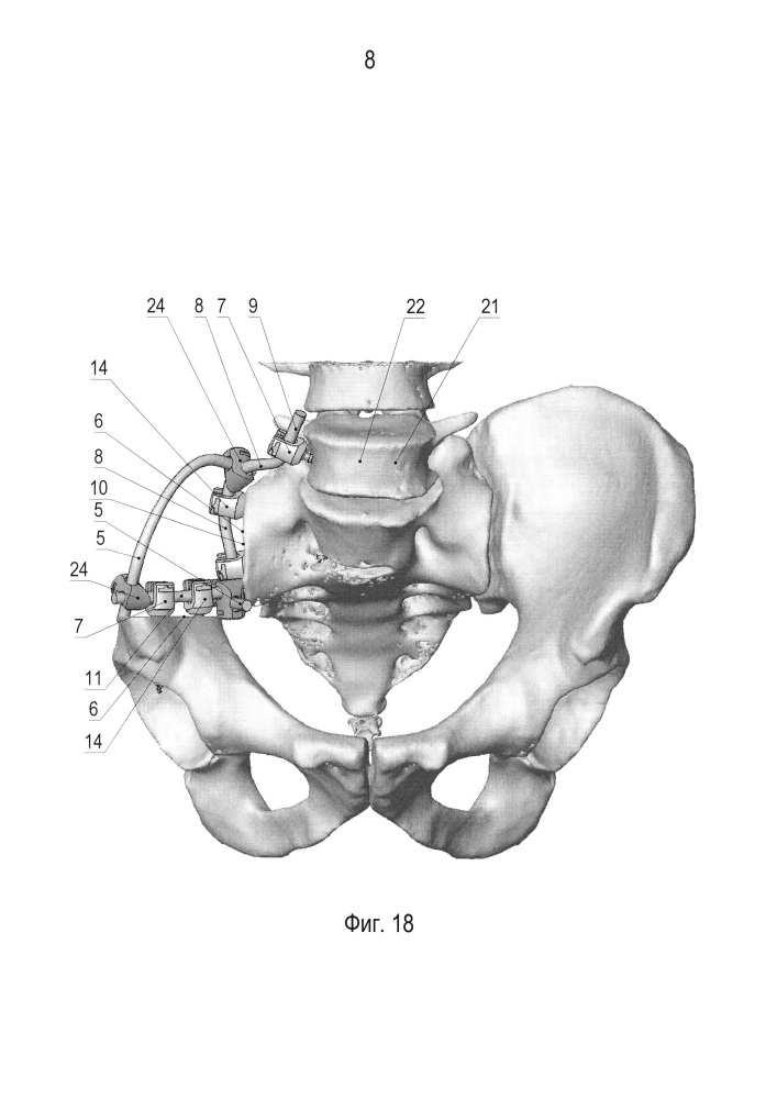 Устройство для реконструкции костей таза (патент 2626122)