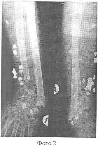 Способ хирургического лечения сегментарных дефектов диафизов костей предплечья (патент 2358677)