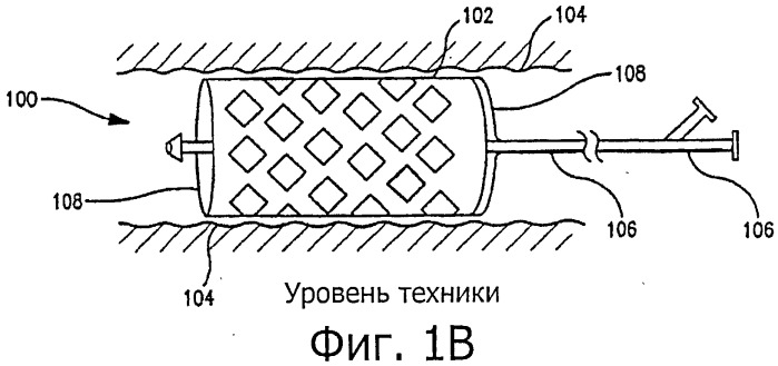 Средство фиксации медицинского устройства, пригодное для стентов, расширяемых с помощью баллона (патент 2512816)