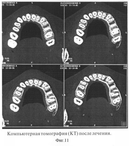 Способ прогнозирования ортодонтической коррекции ретенции верхних постоянных клыков (патент 2269968)