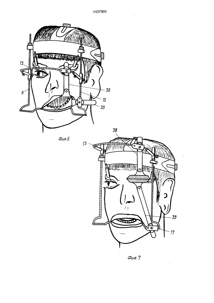 Устройство ю.п.богача для прицельных манипуляций на голове (патент 1457903)
