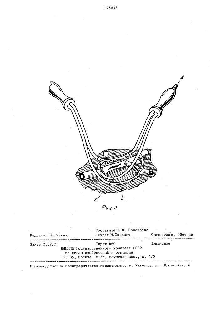Кровоостанавливающее устройство (патент 1228833)