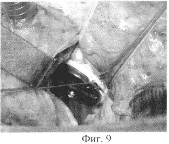 Способ имплантации механического протеза клапана сердца (патент 2454204)