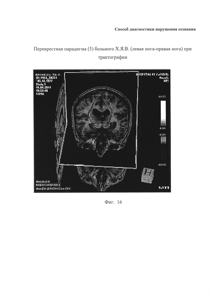 Способ диагностики нарушения сознания (патент 2596049)