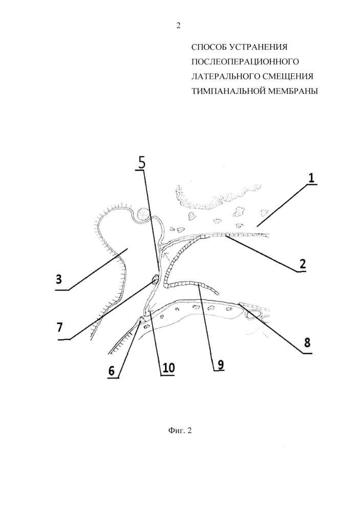 Способ устранения послеоперационного латерального смещения тимпанальной мембраны (патент 2648177)