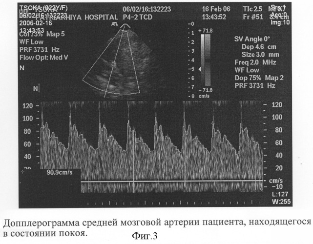 Способ диагностики ауторегуляции сосудов головного мозга (патент 2311133)