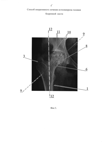 Способ оперативного лечения остеонекроза головки бедренной кости (патент 2578833)