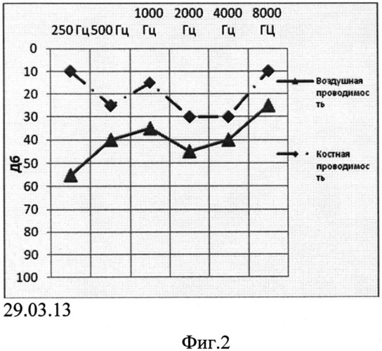 Способ восстановления оссикулярной системы при тимпанопластике (патент 2546093)