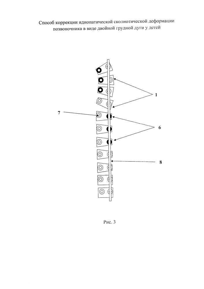 Способ коррекции идиопатической сколиотической деформации позвоночника в виде двойной грудной дуги у детей (патент 2651111)