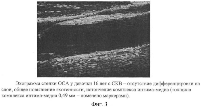 Способ диагностики системной красной волчанки и антифосфолипидного синдрома у детей (патент 2435524)