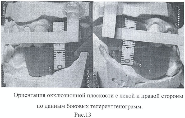 Способ протезирования встречных концевых дефектов зубных рядов (патент 2432117)