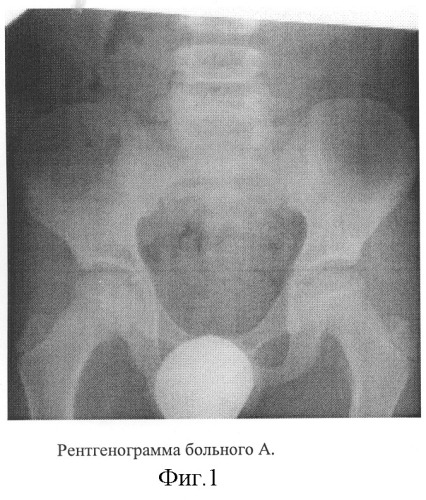 Способ диагностики остеохондропатии тазобедренного сустава (патент 2257573)