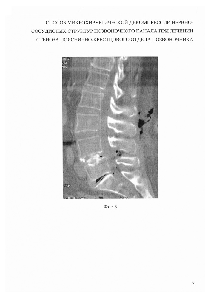 Способ микрохирургической декомпрессии нервно-сосудистых структур позвоночного канала при лечении стеноза пояснично-крестцового отдела позвоночника (патент 2628653)
