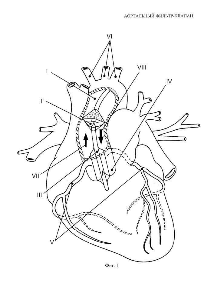 Аортальный фильтр-клапан (патент 2661031)