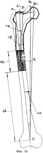 Способ удлинения бедренной кости с одновременным восстановлением биомеханической оси конечности (патент 2441617)